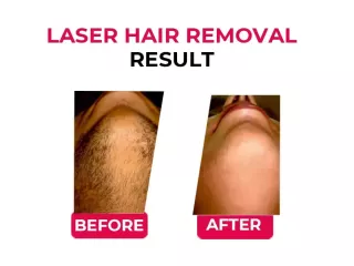 best-laser-hair-removal-treatment-in-india-small-1