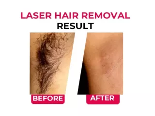 best-laser-hair-removal-treatment-in-india-small-2