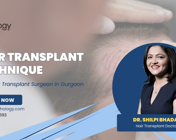 hair-transplant-clinic-in-gurgaon-best-hair-transplant-technique