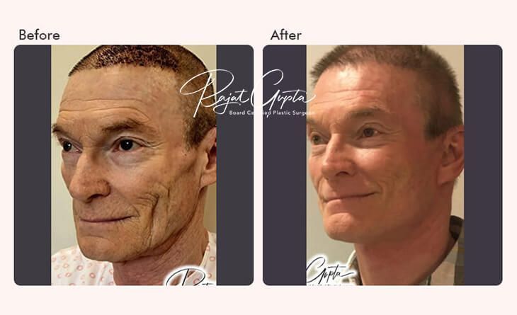 how-to-choose-the-best-facelift-surgery-clinic-in-india-big-0