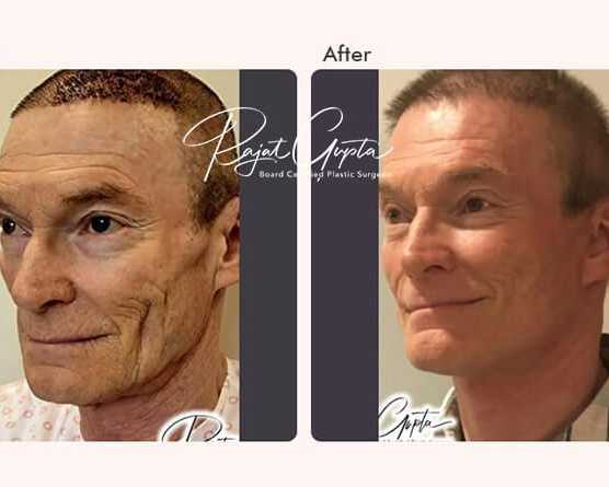 how-to-choose-the-best-facelift-surgery-clinic-in-india