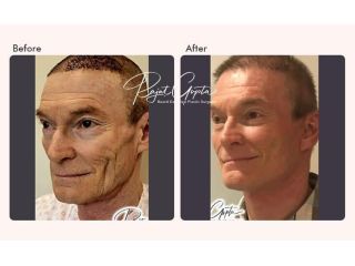 how-to-choose-the-best-facelift-surgery-clinic-in-india-small-0