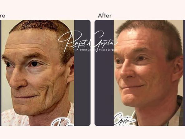 how-to-choose-the-best-facelift-surgery-clinic-in-india