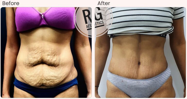 tummy-tuck-surgery-cost-in-delhi-dr-rajat-gupta-big-0