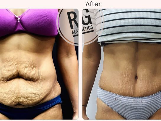 tummy-tuck-surgery-cost-in-delhi-dr-rajat-gupta