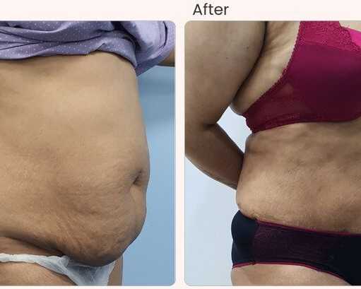 liposuction-surgery-in-delhi-dr-rajat-gupta