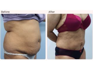 liposuction-surgery-in-delhi-dr-rajat-gupta-small-0