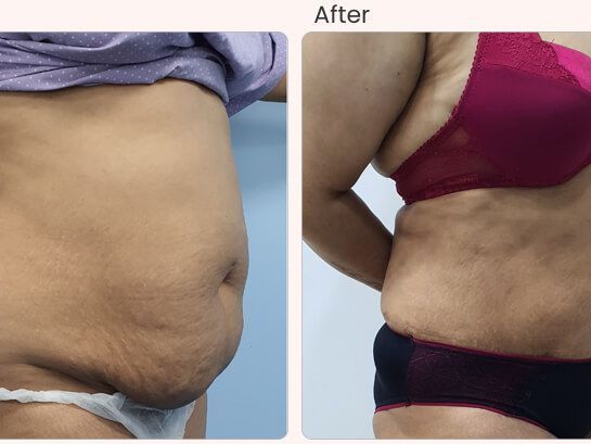 liposuction-surgery-in-delhi-dr-rajat-gupta