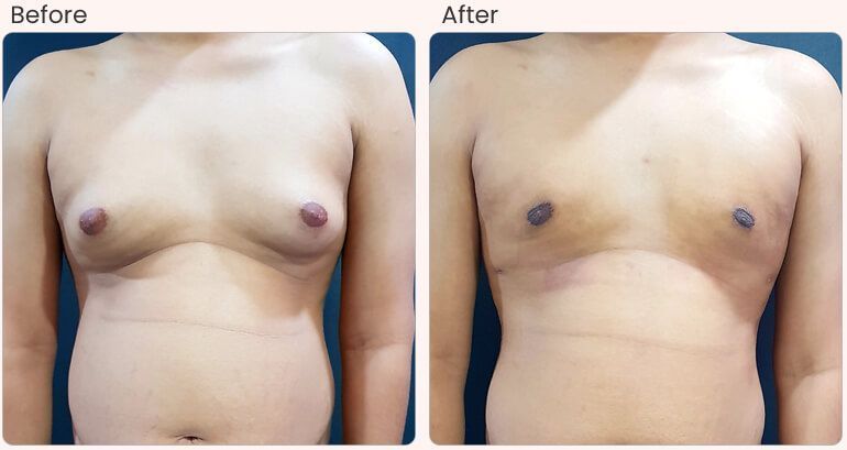 gynecomastia-surgery-cost-in-delhi-dr-rajat-gupta-big-0