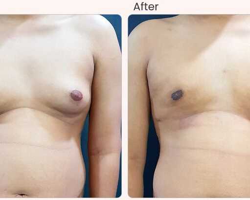 gynecomastia-surgery-cost-in-delhi-dr-rajat-gupta