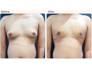 gynecomastia-surgery-cost-in-delhi-dr-rajat-gupta-small-0