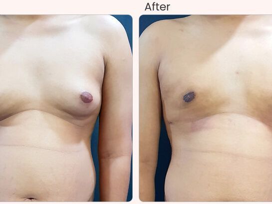 gynecomastia-surgery-cost-in-delhi-dr-rajat-gupta