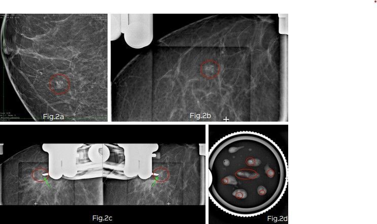 stereotactic-vacuum-assisted-breast-biopsy-in-mumbai-picture-this-big-0