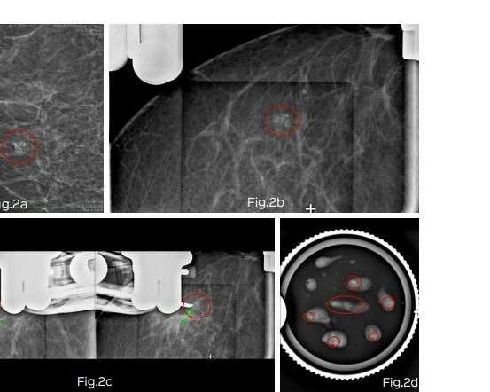 stereotactic-vacuum-assisted-breast-biopsy-in-mumbai-picture-this