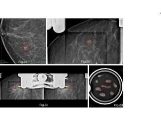 stereotactic-vacuum-assisted-breast-biopsy-in-mumbai-picture-this-small-0