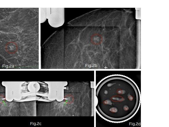 stereotactic-vacuum-assisted-breast-biopsy-in-mumbai-picture-this