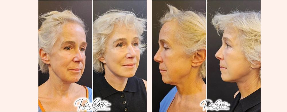 schedule-facelift-surgery-consultation-with-certified-surgeons-big-0