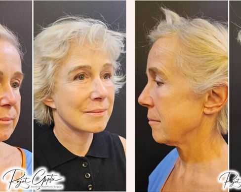 schedule-facelift-surgery-consultation-with-certified-surgeons