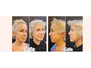 schedule-facelift-surgery-consultation-with-certified-surgeons-small-0