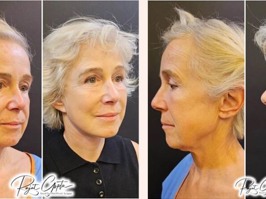 schedule-facelift-surgery-consultation-with-certified-surgeons
