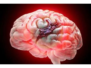 get-best-brain-hemorrhage-treatment-in-india-at-irfacilities-small-0