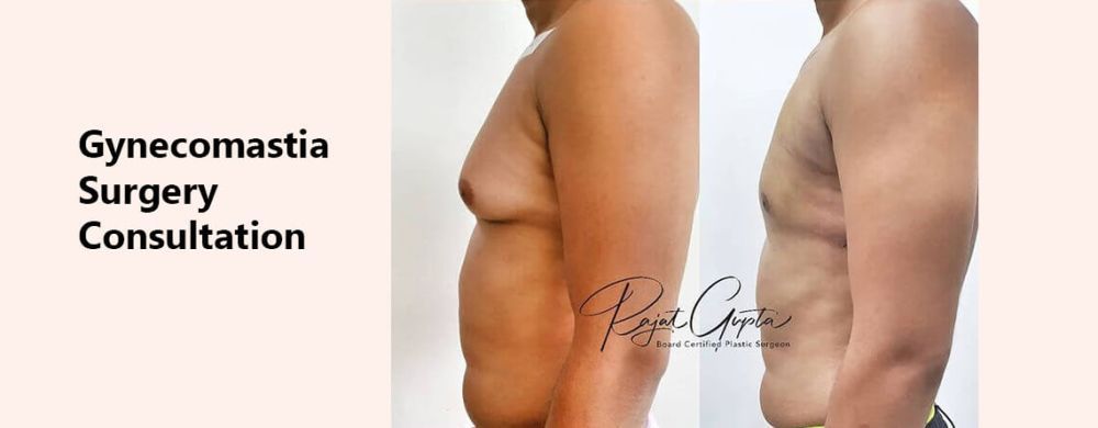 gynecomastia-surgery-consultation-online-how-to-prepare-big-0
