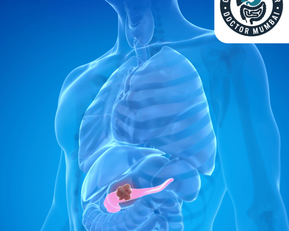 advanced-pancreatic-cancer-treatment-in-mumbai-with-expert-care