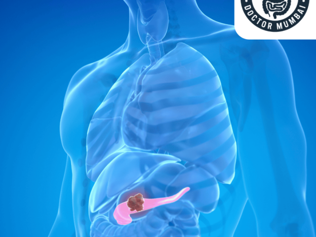 advanced-pancreatic-cancer-treatment-in-mumbai-with-expert-care