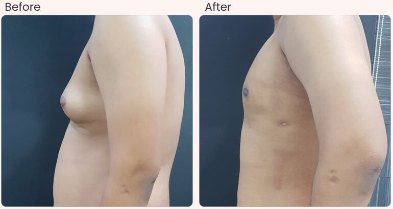 common-side-effects-and-risks-of-gynecomastia-surgery-big-0