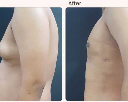 common-side-effects-and-risks-of-gynecomastia-surgery