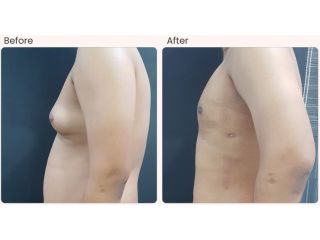 common-side-effects-and-risks-of-gynecomastia-surgery-small-0