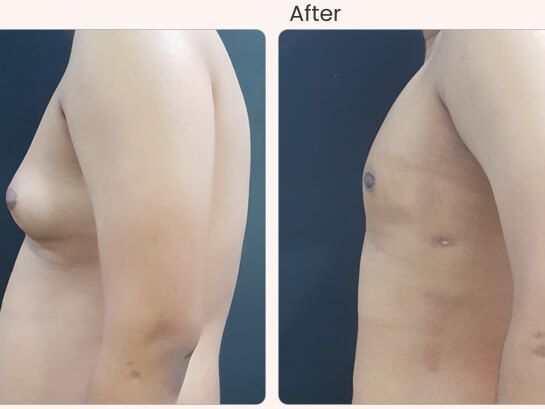 common-side-effects-and-risks-of-gynecomastia-surgery