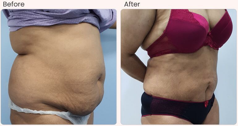 liposuction-surgery-cost-in-delhi-dr-rajat-gupta-big-0