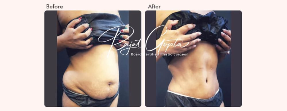 latest-tummy-tuck-surgery-techniques-available-today-big-0