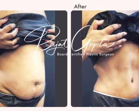 latest-tummy-tuck-surgery-techniques-available-today