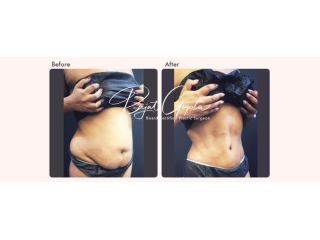 latest-tummy-tuck-surgery-techniques-available-today-small-0