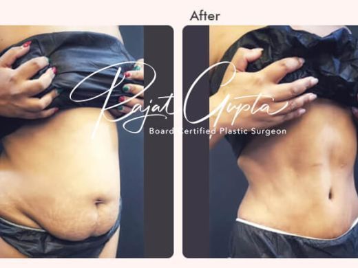 latest-tummy-tuck-surgery-techniques-available-today