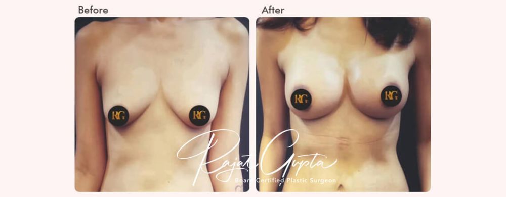 breast-augmentation-surgery-financing-options-in-india-big-0