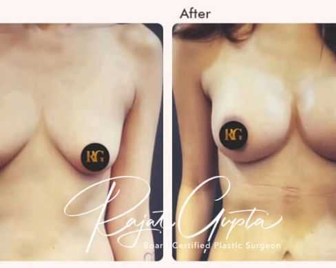 breast-augmentation-surgery-financing-options-in-india