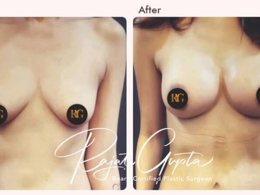 breast-augmentation-surgery-financing-options-in-india