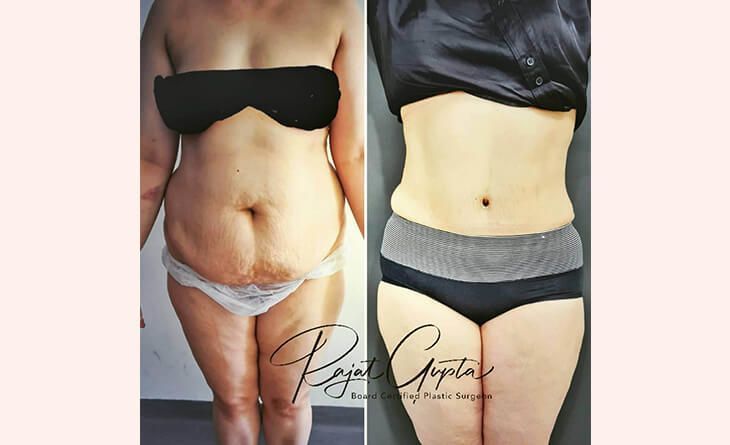 virtual-consultations-for-tummy-tuck-surgery-what-you-need-to-know-big-0