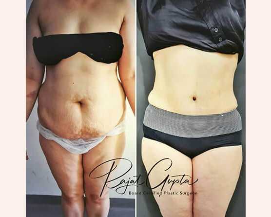 virtual-consultations-for-tummy-tuck-surgery-what-you-need-to-know