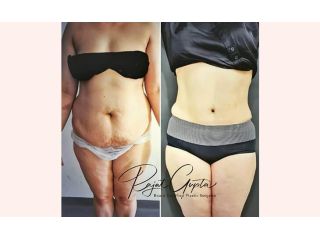 virtual-consultations-for-tummy-tuck-surgery-what-you-need-to-know-small-0