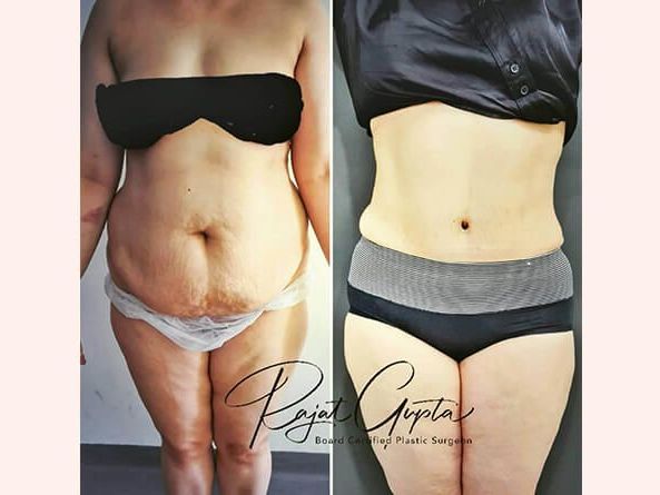 virtual-consultations-for-tummy-tuck-surgery-what-you-need-to-know