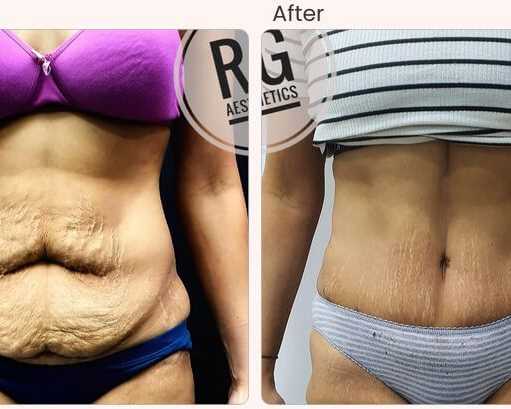 tummy-tuck-surgery-in-delhi-dr-rajat-gupta