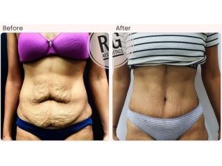 tummy-tuck-surgery-in-delhi-dr-rajat-gupta-small-0