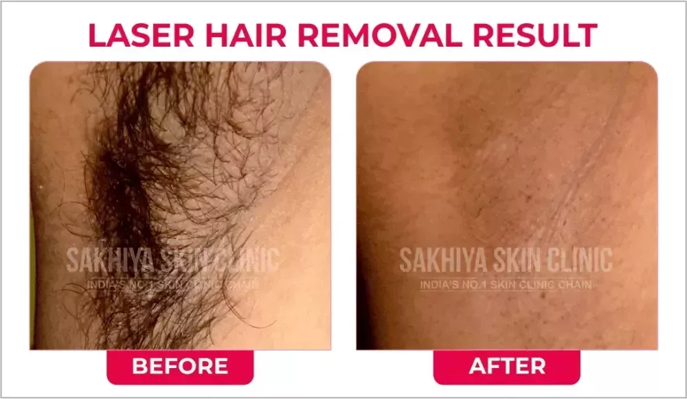 sakhiya-skin-clinic-best-skin-clinic-for-laser-hair-removal-in-surat-big-0