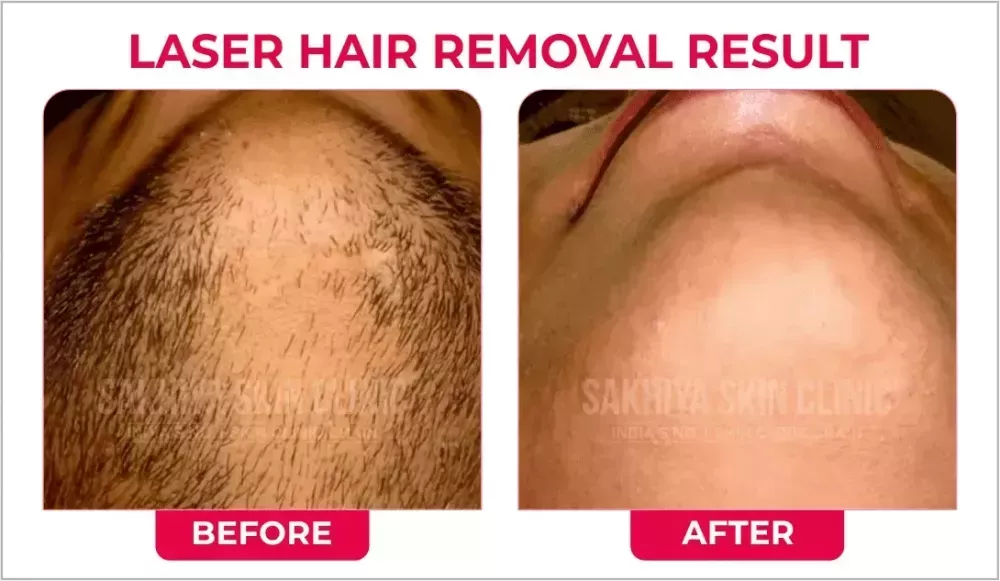 sakhiya-skin-clinic-best-skin-clinic-for-laser-hair-removal-in-surat-big-1