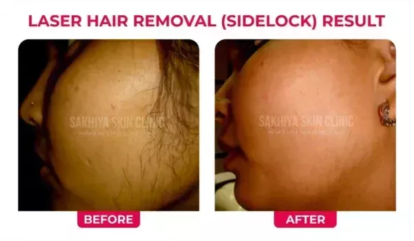 sakhiya-skin-clinic-best-skin-clinic-for-laser-hair-removal-in-surat-big-2