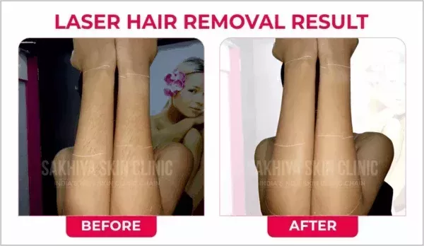 sakhiya-skin-clinic-best-skin-clinic-for-laser-hair-removal-in-surat-big-3
